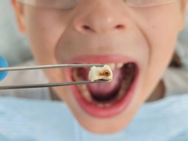 Best Emergency Tooth Extraction in Jessup, PA